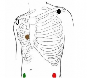 心電監(jiān)護(hù)5個電極位置圖，電極片放置位置在哪？