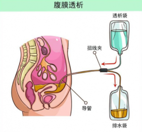 腹膜透析液的成分及作用解析