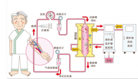 血液透析設備的維護與保養(yǎng)|朗逸百科