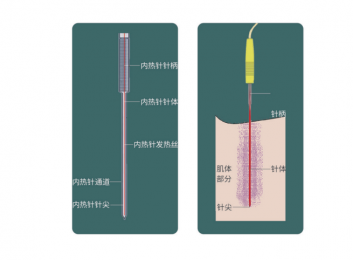 什么是內(nèi)熱式針灸治療儀?內(nèi)熱針的作用原理