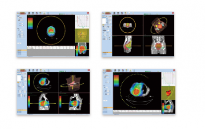 三維放射治療計劃系統(tǒng)：高精度的圖像