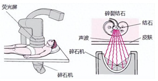 體內沖擊波膽道碎石儀操作流程解析