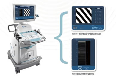 超聲瞬時彈性成像優缺點|超聲瞬時彈性成像特點