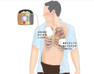 心電圖機的正確使用步驟是什么？朗逸器械百科