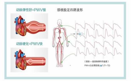 動脈硬化檢測儀：品牌推薦與選購指南