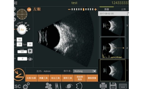 眼科ab型超聲