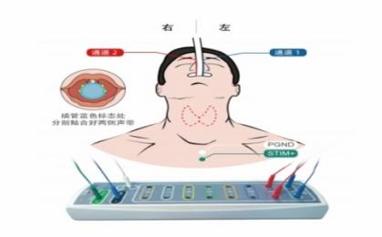 喉返神經監測儀生產廠家直供，國產VS進口喉返監測儀！